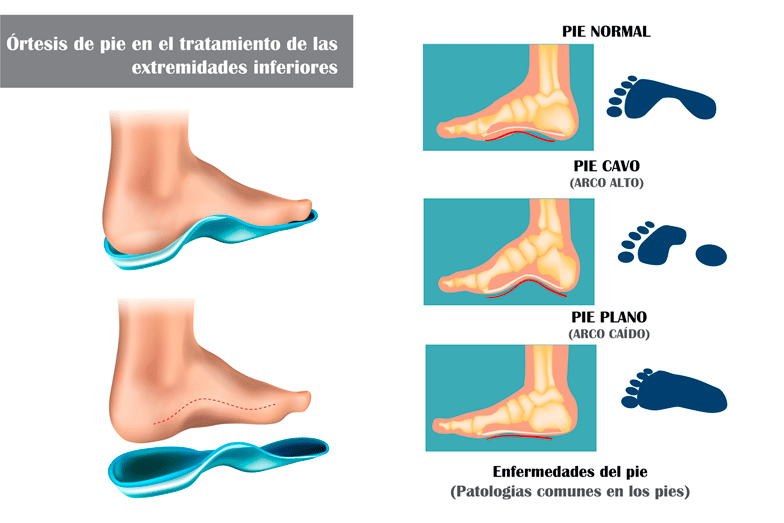 ¿Qué tipo de pie tienes? Conócelo y cuídalo 👣